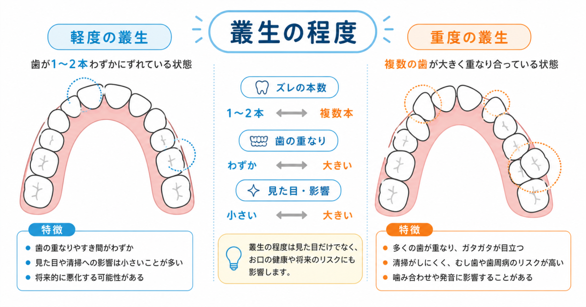 ■八重歯・ガタガタの歯並びは「叢生（そうせい）」という不正咬合