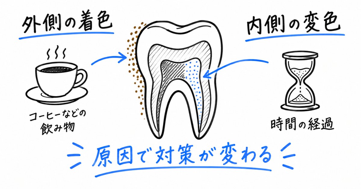 歯の黄ばみの原因から判断する自力ケアの限界と歯科の役割